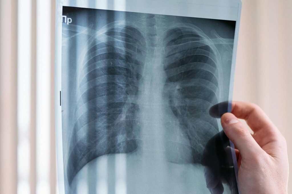 A imagem mostra uma radiografia de tórax sendo segurada por uma mão. A radiografia exibe os pulmões e a estrutura torácica, com detalhes visíveis das costelas e do coração. Ao fundo, há uma janela com persianas, criando um efeito de luz suave.